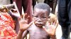Monkeypox-8-10-17.jpg